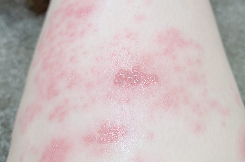 帯状疱疹と蕁麻疹の症状